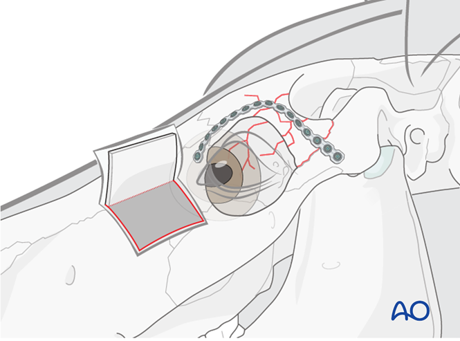 Plate fixation for Orbital fractures