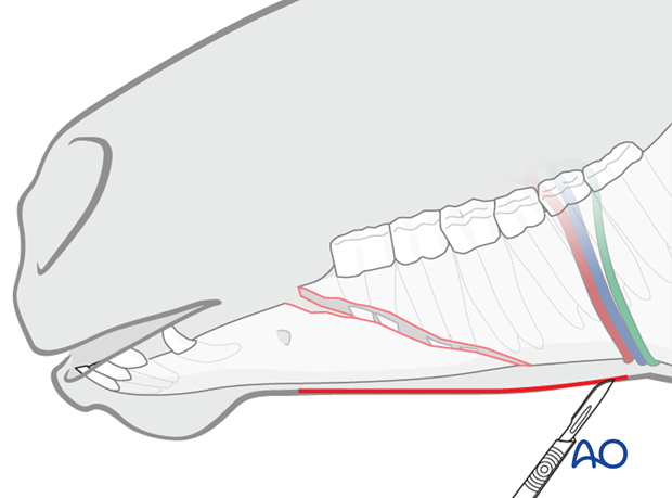 submandibular approach to interdental space unilateral or bilateral fractures