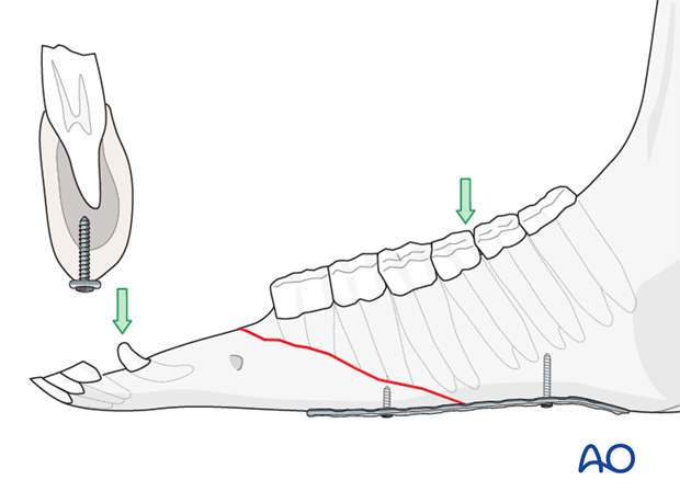 plate fixation