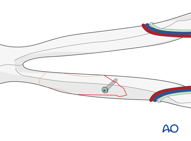 plate fixation