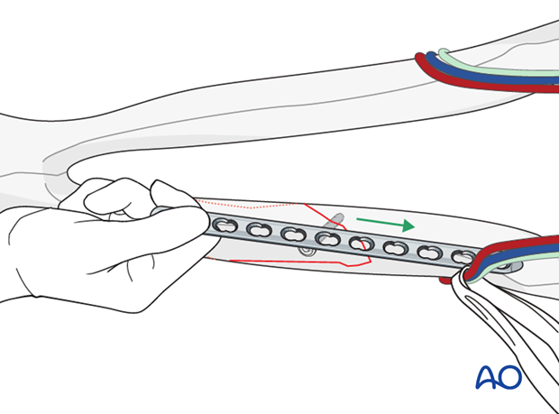 plate fixation