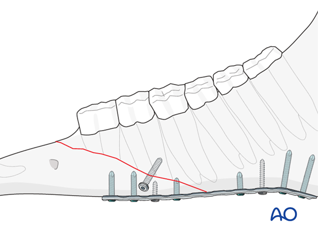 mandible horizontal ramus interdental space unilateral