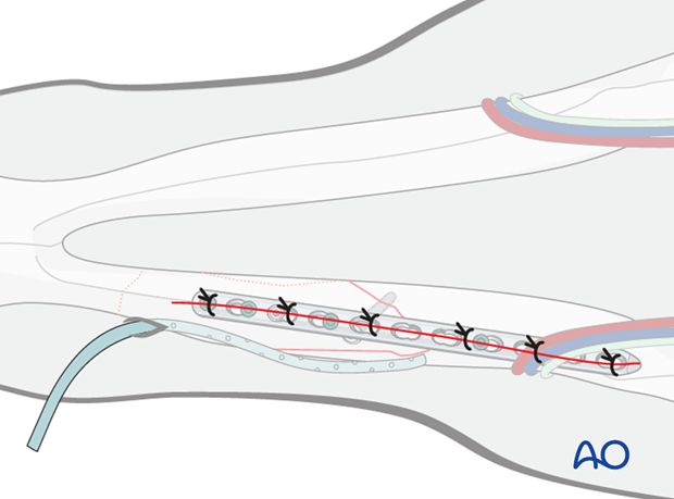 plate fixation