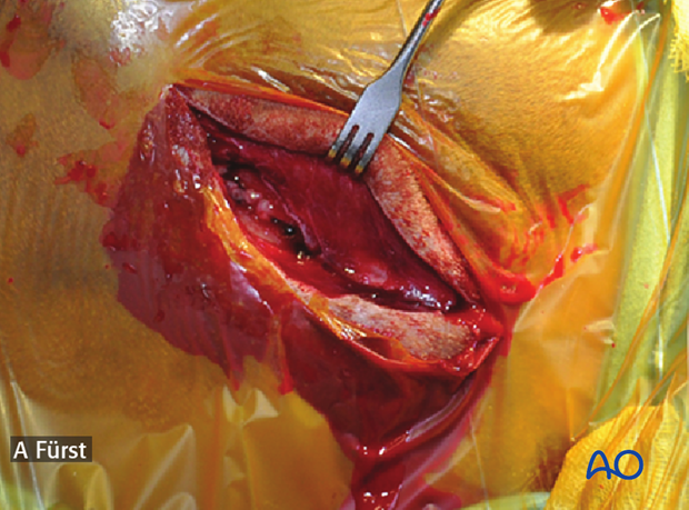 approach to the parietal bone