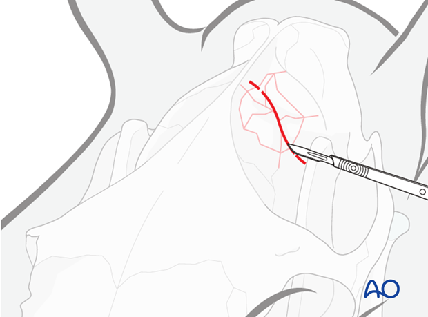 approach to the parietal bone