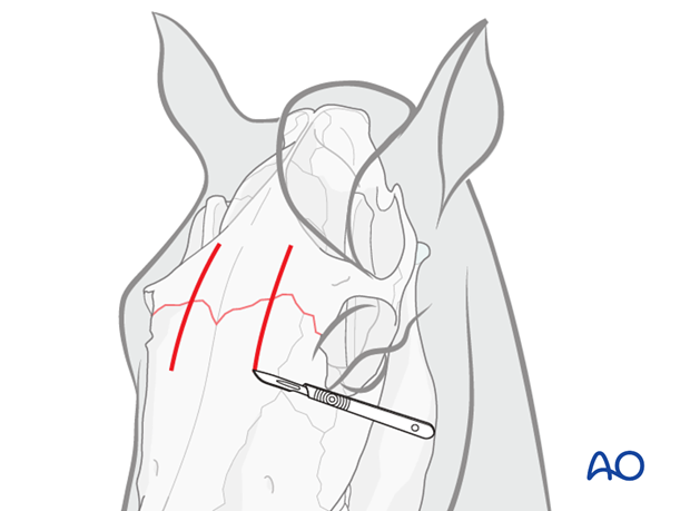 approach to suture periostitis