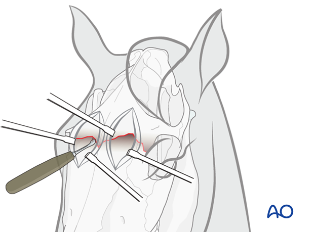 approach to suture periostitis