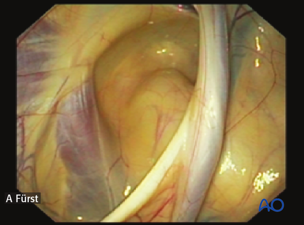 approach to paracondylar process