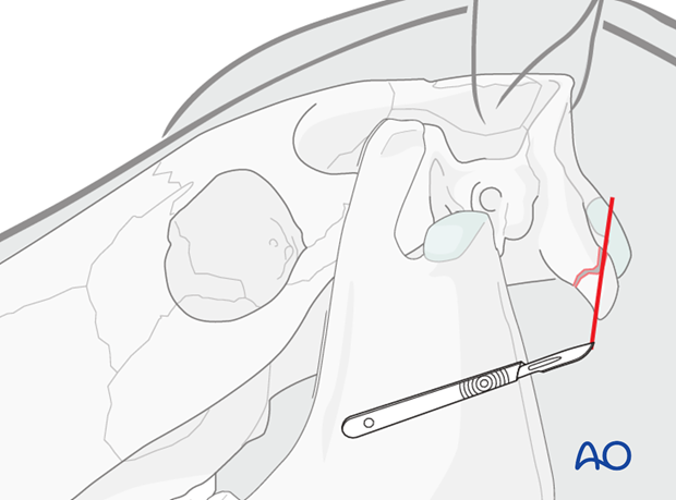 approach to paracondylar process