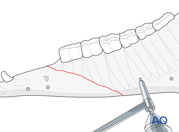 stab incisions external fixator