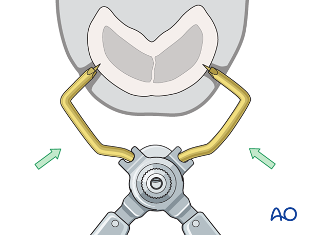 stab incisions external fixator