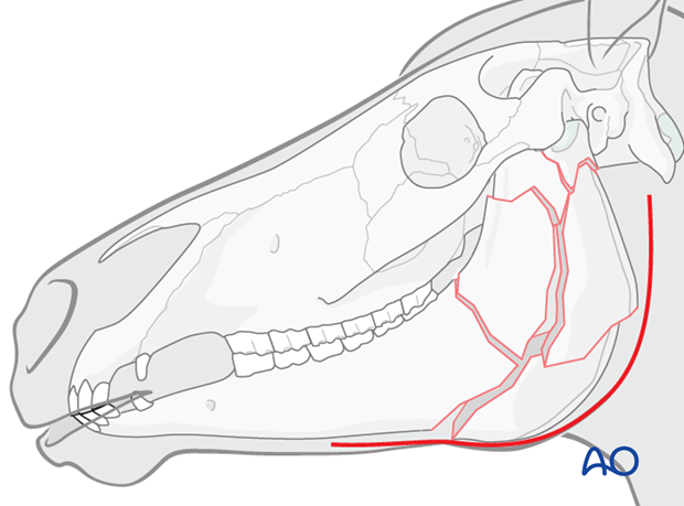 approach to vertical ramus