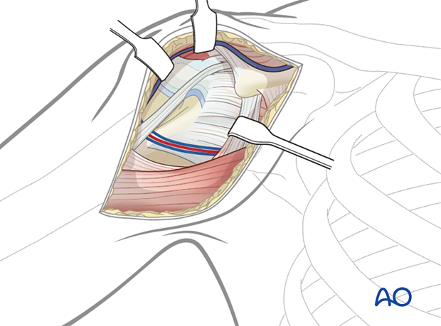 Deltopectoral approach for proximal humeral fractures: access to structures; no adult extensile approach needed, limited to soft-tissue and fracture reduction.