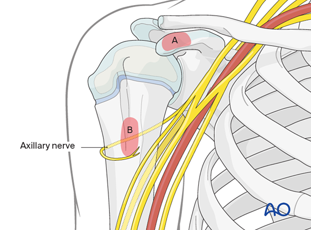 Anatomical landmarks for the anterior deltopectoral approach: coracoid process (A) and proximal humeral shaft (B) at the axilla; both are easily palpable.