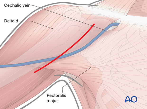 Incision between coracoid process and proximal humeral shaft; straight or curved per surgeon's preference.