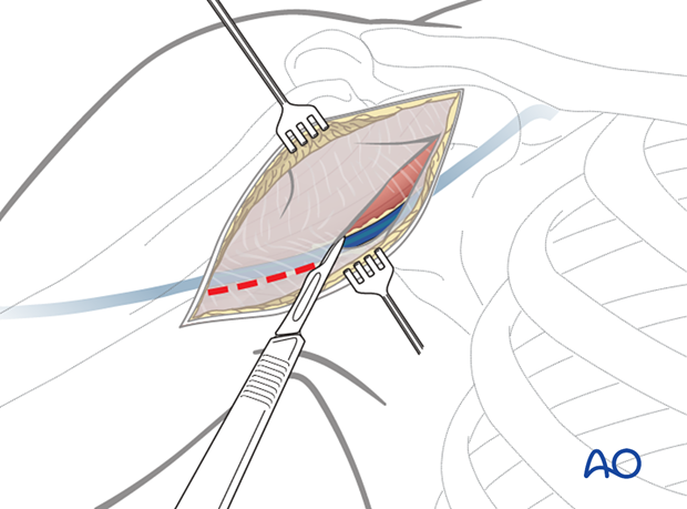 Expose the deltopectoral groove and cephalic vein, identifiable by muscle fibers, the vein, and surrounding fat. If unsure, find the groove at the incision's ends.