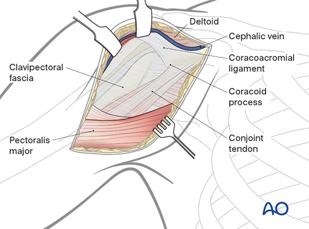 Retract cephalic vein laterally/medially; open fascia. Lateral retraction risks damage; preserve vein to reduce edema. Identify groove to avoid dissection complications. Blunt dissection to expose clavipectoral fascia.