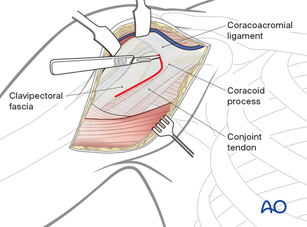 Identify the coracoid process and conjoint tendon. Incise clavipectoral fascia lateral to the tendon and inferior to the coracoacromial ligament.