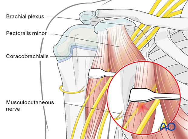 Pitfall: Musculocutaneous nerve exits coracobrachialis ~2.5 cm distal to coracoid tip. Retractors under conjoined tendon can cause neurapraxia; avoid vigorous retraction.