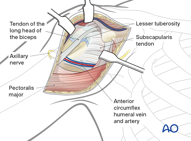 Retract deltoid laterally and conjoined tendon medially. Expose proximal humerus; confirm landmarks and evaluate fracture. Resection of hemorrhagic bursa if needed. Avoid axillary nerve damage with retractors.