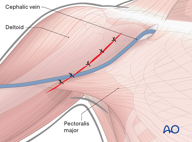 Irrigate the wound. Close deltopectoral groove, subcutaneous tissues, and skin.