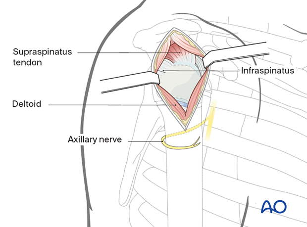 Lateral approach with deltoid splitting