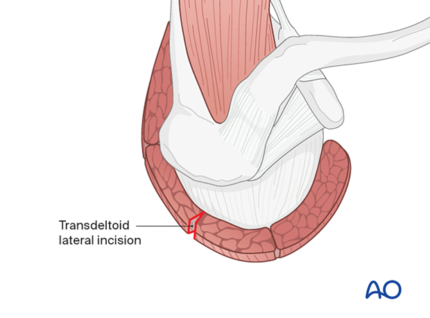 Incision in middle deltoid muscle; may extend distally based on fracture morphology and osteosynthesis. Protect axillary nerve.