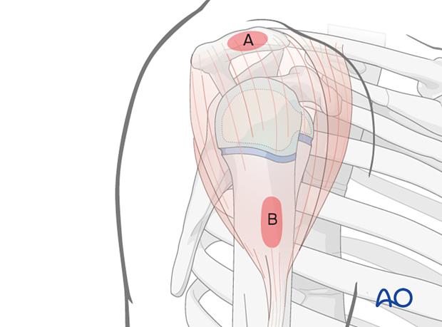 Landmarks for transdeltoid lateral approach: lateral acromion (A) and lateral proximal humeral shaft (B); both easily palpable.