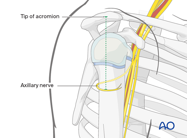 The axillary nerve runs dorsolaterally around the humeral metaphysis, averaging 5 cm distal to the acromion tip in children 6+ years.