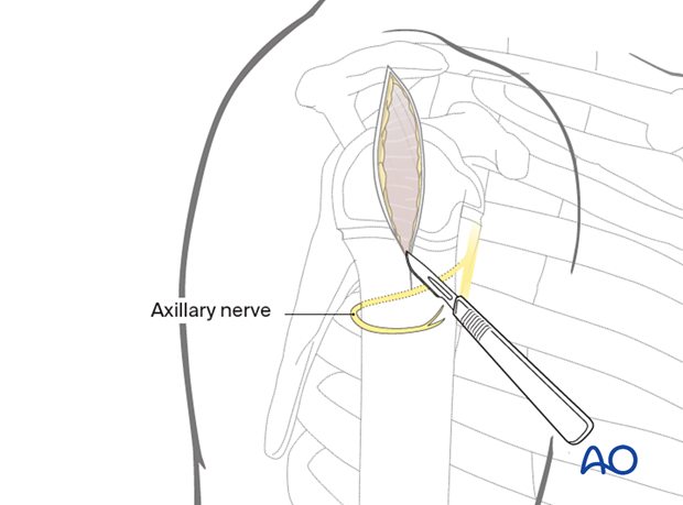 Make a skin incision from the lateral acromion border, parallel to the humerus axis.