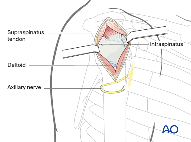 Expose the middle third of the deltoid; split fibers up to the acromion. Palpate the axillary nerve distally. Excise hemorrhagic subdeltoid bursa to expose the humeral head. Place a stay suture at the deltoid split's inferior border to protect the axillary nerve.