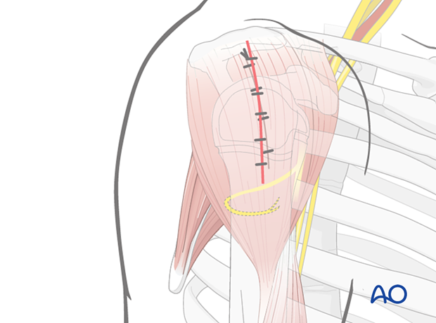 Irrigate the wound. Close deltoid fascia, subcutaneous tissues, and skin.