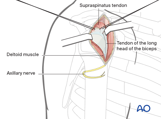 Anterolateral approach to the proximal humerus