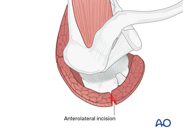 Incision between anterior and middle deltoid; extend if needed. Protect axillary nerve.