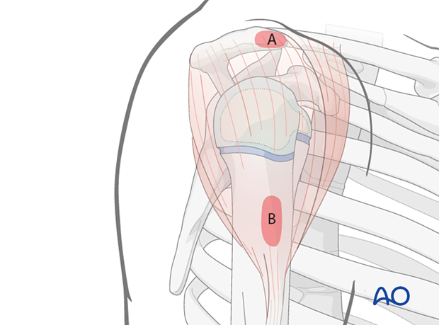 Anterolateral approach landmarks: anterolateral acromion edge (A) and lateral proximal humeral shaft (B); both easily palpable.