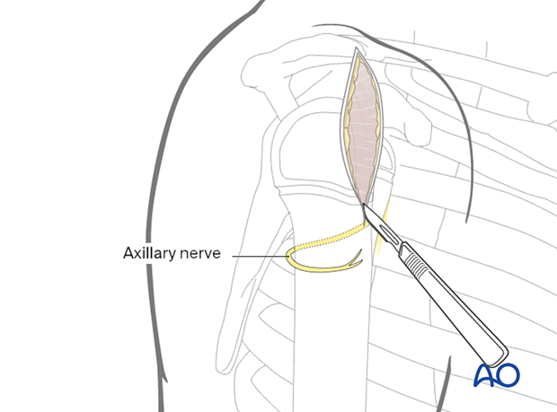 Make a skin incision from the anterior acromion border, parallel to the humerus axis.