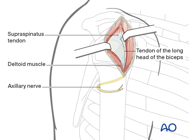 Split deltoid between anterior and medial fibers to acromion. Palpate axillary nerve distally. Excise bursa if needed. Use stay suture to protect axillary nerve.