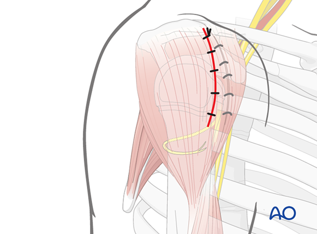 Irrigate wound. Close deltoid interval, subcutaneous tissue, and skin.