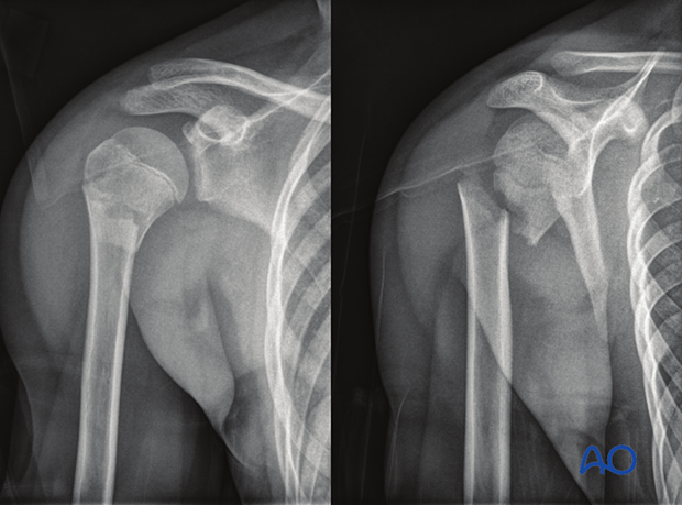 Fractures visible on plain x-rays; AP and lateral shoulder views are sufficient; avoid transthoracic views.