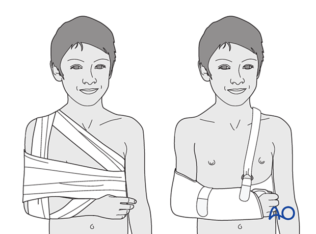 Sling immobilization