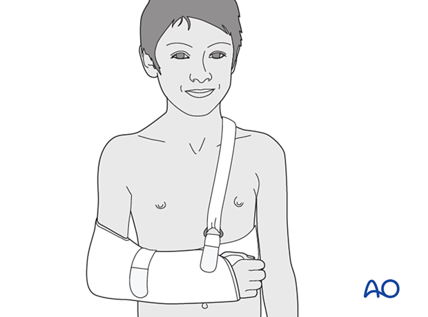 A shoulder immobilizer is suitable for older children and can be used with or without a body strap.