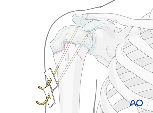 K-wire fixation of a Salter-Harris type-II fracture of the pediatric proximal humerus 