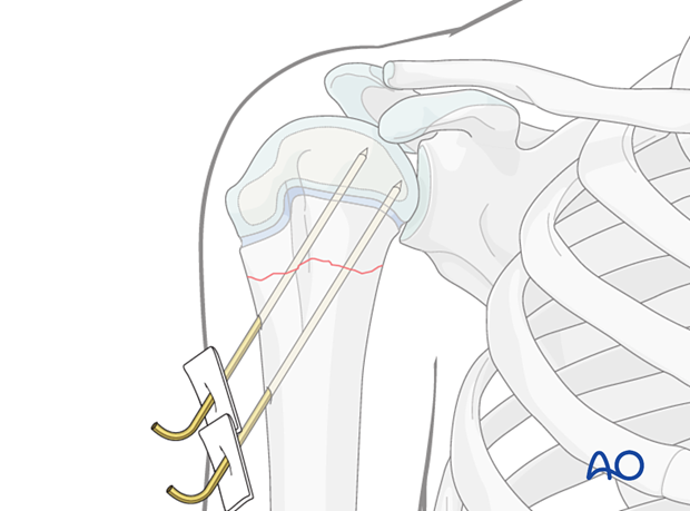 K-wire fixation of a simple metaphyseal fracture of the pediatric proximal humerus