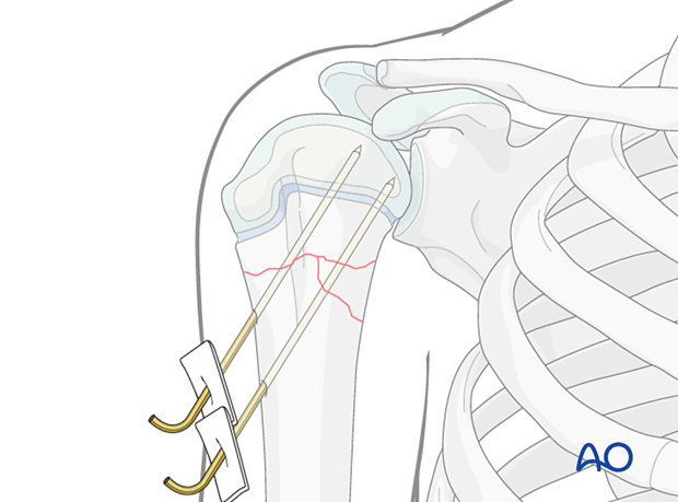 K-wire fixation of a multifragmentary metaphyseal fracture of the pediatric proximal humerus