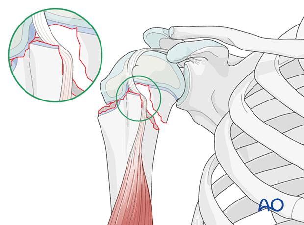 Biceps tendon entrapment in a Salter-Harris type-II fracture of the pediatric proximal humerus