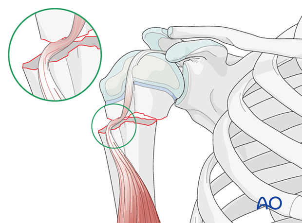 Biceps tendon entrapment in a simple metaphyseal fracture of the pediatric proximal humerus