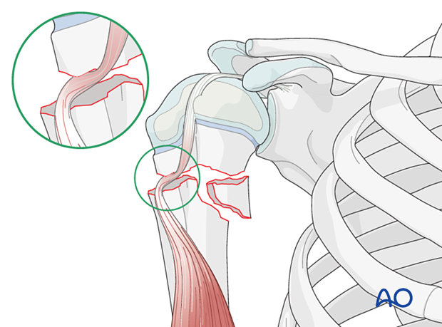 Biceps tendon entrapment in a multifragmentary metaphyseal fracture of the pediatric proximal humerus