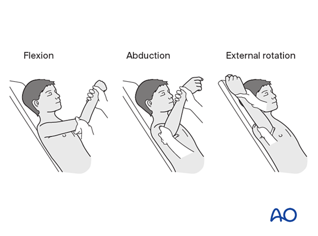 Reduction maneuvers for closed reduction of a Salter-Harris type-II fracture of the pediatric proximal humerus