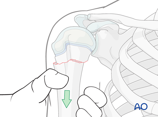 Closed reduction of a simple metaphyseal fracture of the pediatric proximal humerus
