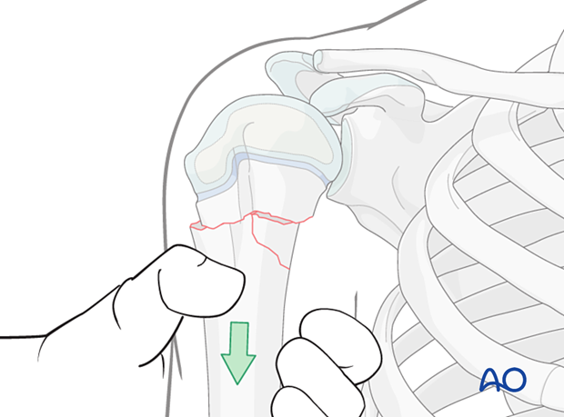 Closed reduction of a multifragmentary metaphyseal fracture of the pediatric proximal humerus